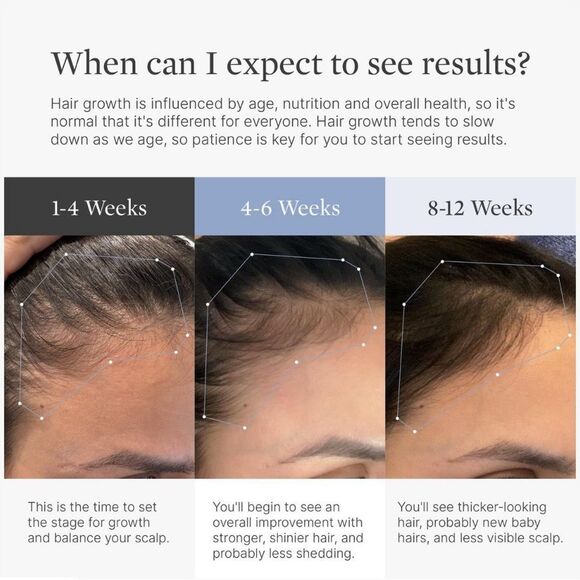 Superpower Thickening Hairpatches - Gold - Picture 8 of 10